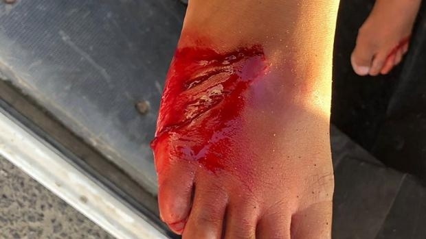 بالصور .. طفل إسباني ينجو بإعجوبة من عضة سمكة قرش أثناء السباحة