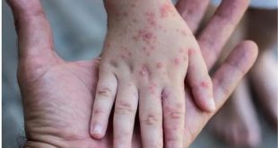 أمريكا ترصد أول إصابتين لجدري القردة لدى الأطفال وظهور أعراض على رضيع