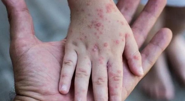 اكتشاف أول 5 حالات إصابة بجدرى القردة فى تركيا