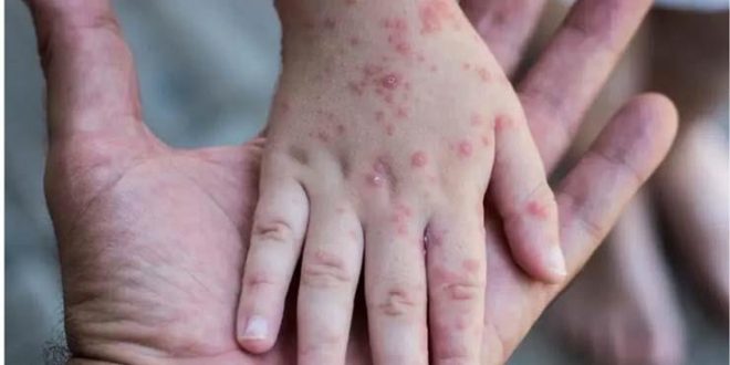 ظهور أول حالة جدري قرود بمصر ونقل المريض من مستشفي السلام لحميات العباسية