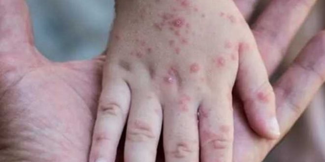 البحرين تنضم إلى 4 دول عربية وتعلن وصول أول إصابة بجدري القرود