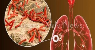 مصر تكشف حقيقة ظهور سلالات جديدة من مرض الدرن