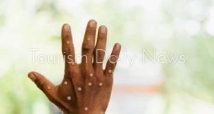 رصد 3 إصابات بجدري القردة لدى مسافرين وصولوا من الإمارات لباكستان